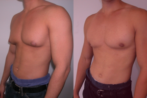 Gynecomastia, What Is It and What Can Be Done?