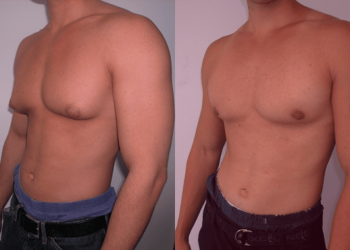 Gynecomastia, What Is It and What Can Be Done?