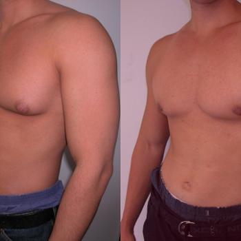Gynecomastia: What Is It and What Can Be Done?