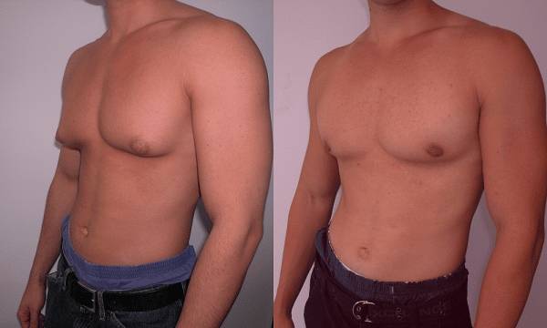 Gynecomastia: What Is It And What Can Be Done?