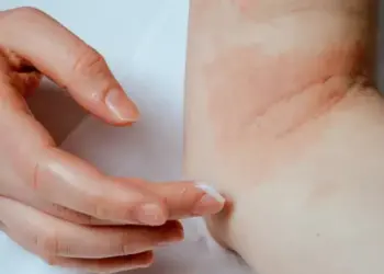 Eczema, Dermatitis, Everything You Need To Know