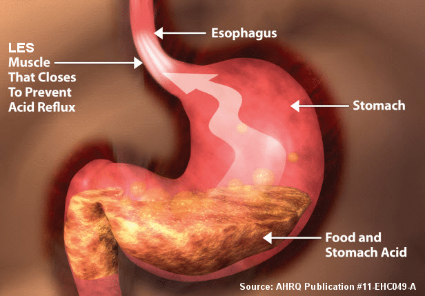 Acid reflux also known as heartburn