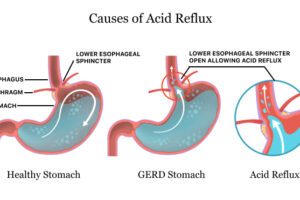 Acid Reflux, Digestive Problems, Their Most Common Symptom