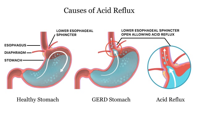 Acid Reflux There Most Common Symptoms