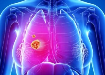 Lung Cancer, New study suggests proton therapy for heart disease